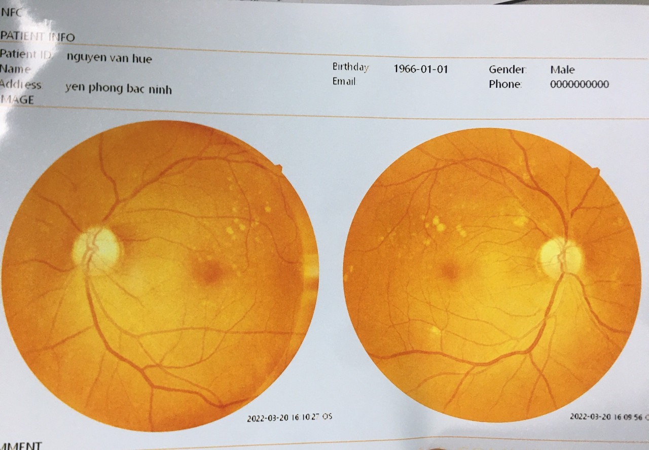 Chụp hình đáy mắt – Bước tiến mới phát hiện và điều trị bệnh lý về mắt
